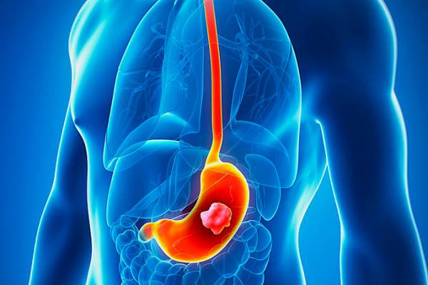 &Kappa;&alpha;&rho;&kappa;ί&nu;&omicron;&sigmaf; &tau;&omicron;&upsilon; &sigma;&tau;&omicron;&mu;ά&chi;&omicron;&upsilon;: &tau;&alpha; &pi;&rho;ώ&iota;&mu;&alpha; &sigma;&eta;&mu;ά&delta;&iota;&alpha; &tau;&omicron;&upsilon; &pi;&omicron;&upsilon; &delta;&epsilon;&nu; &pi;&rho;έ&pi;&epsilon;&iota; &nu;&alpha; &sigma;&upsilon;&gamma;&chi;έ&omicron;&nu;&tau;&alpha;&iota;!