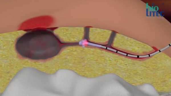 Η θεραπεία της κύστης κόκκυγος με laser - τεχνική SiLaC