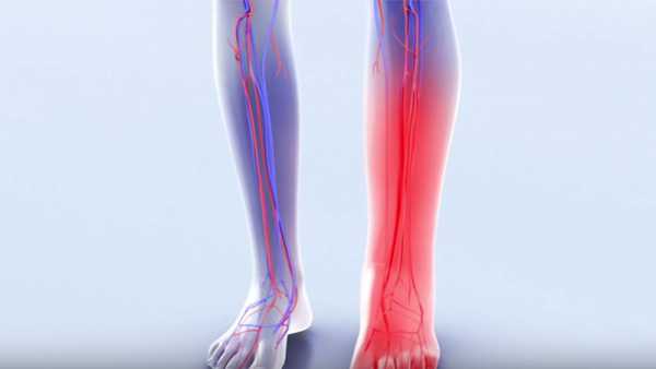 Το μεταθρομβωτικό σύνδρομο, η διάγνωση και οι τρόποι αντιμετώπισής του.